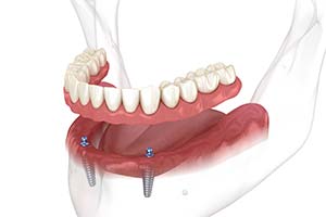 Dental Implants in Charleston, SC