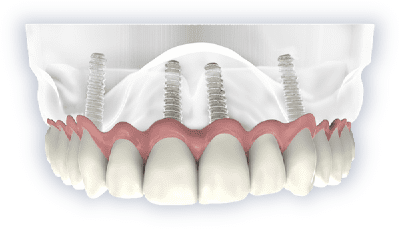 A clear picture of all on 4 dental implants