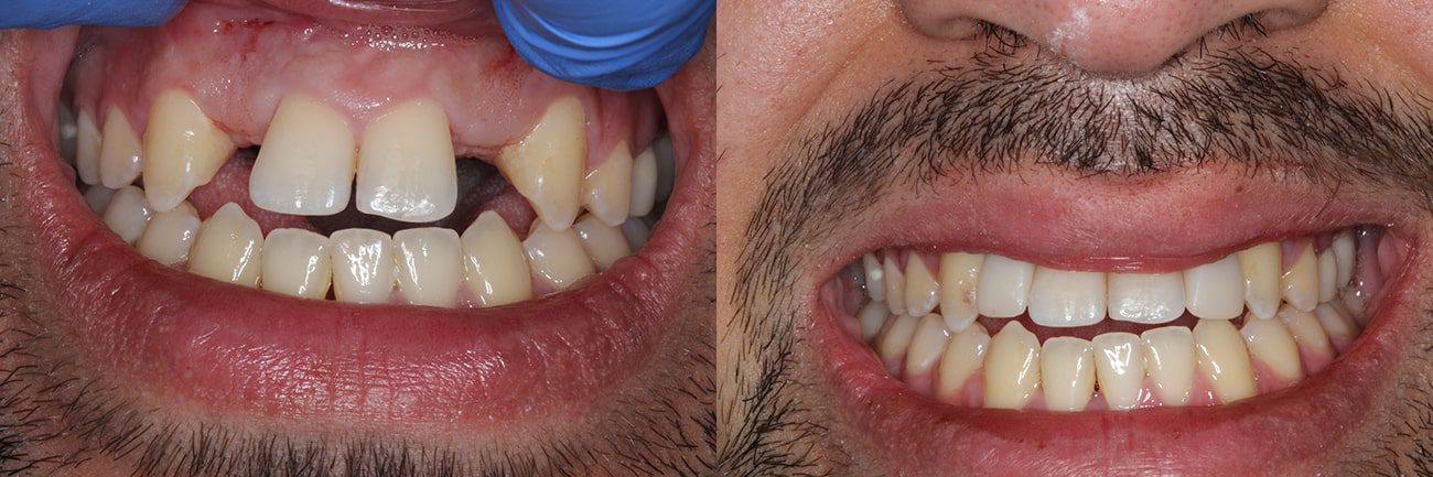 Dental Implants in charleston, sc Before After