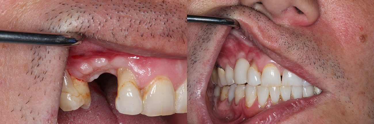 dentists charleston sc Dental Implants Before After