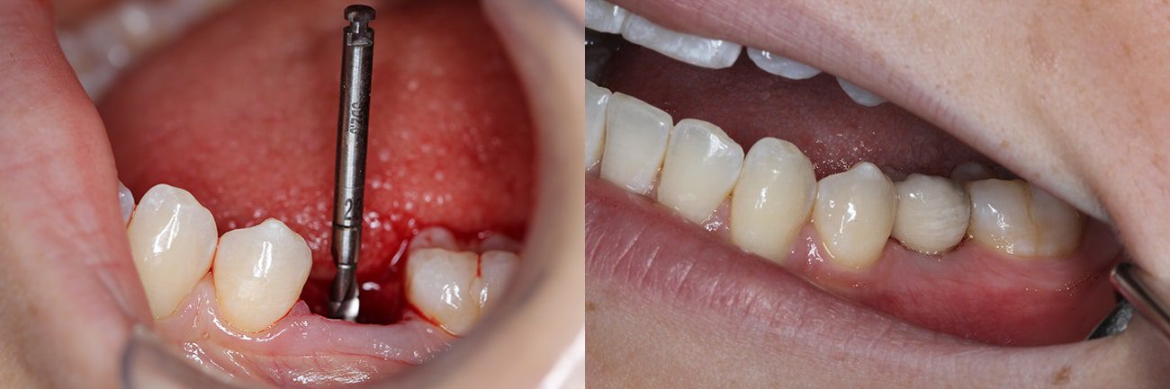 dentist in Summerville Dental Implants Before After