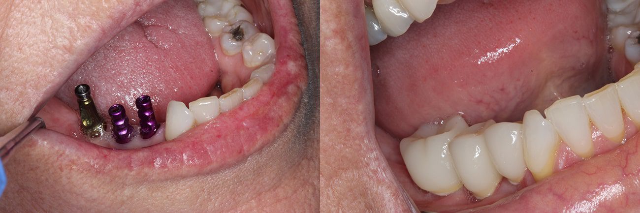 best dentist in charleston sc Dental Implants Before After