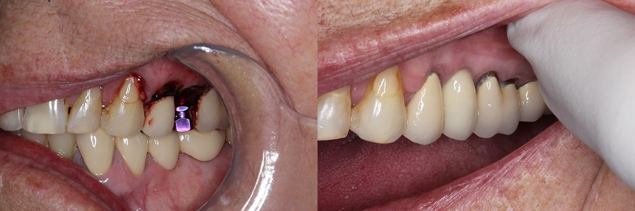 dentist in charleston sc Dental Implants Before After