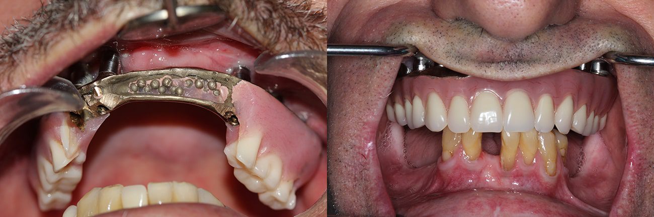 dentist in charleston sc Before After Dental Implants