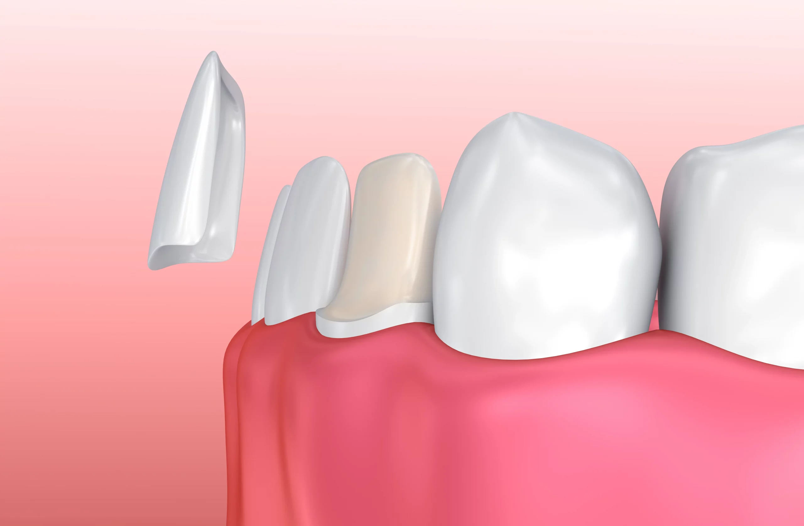 Image of Dental Veneers