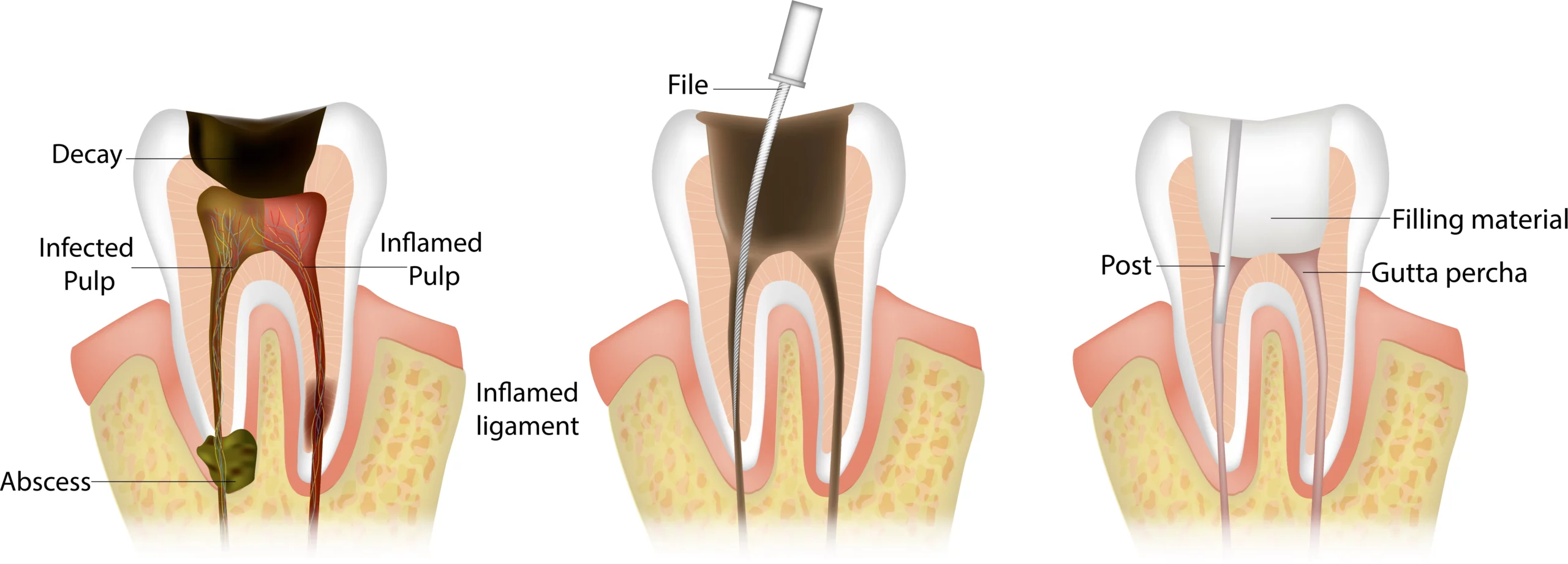 Do Root Canals Hurt and Stages of Root Canal Treatment