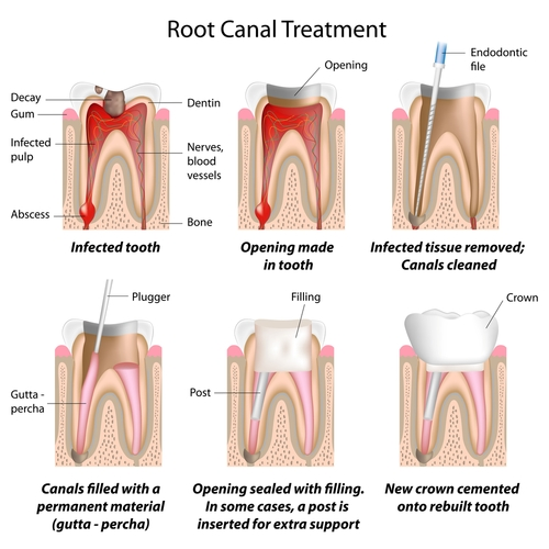 Root Canal Treatment in Camden SC