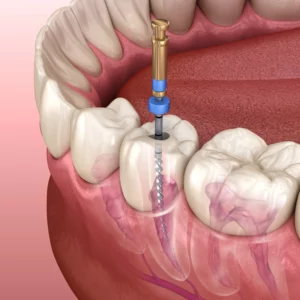 Root Canal Treatment in Charleston SC