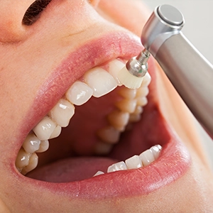 Professional Teeth Cleaning in Charleston, SC
