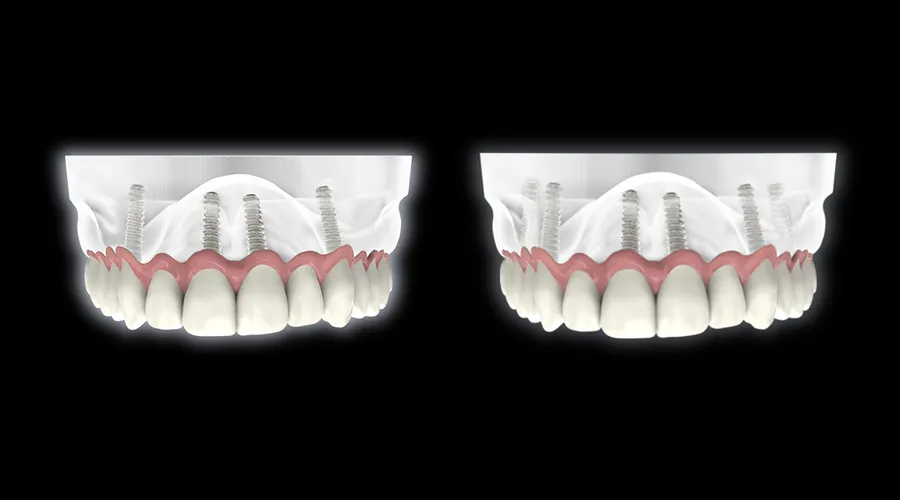 All on 4 Compared To Implant Bridges Which Is Better For You (2)