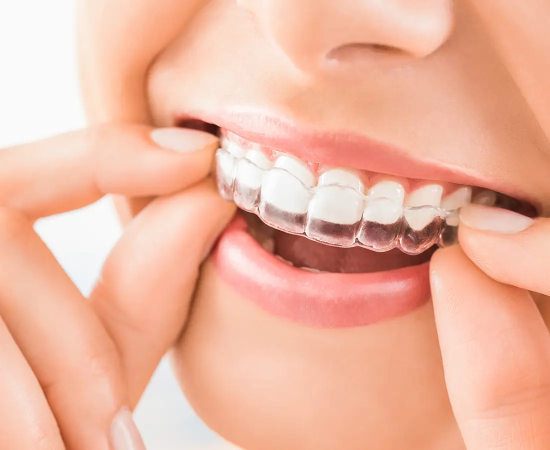 If you want to straighten misaligned teeth