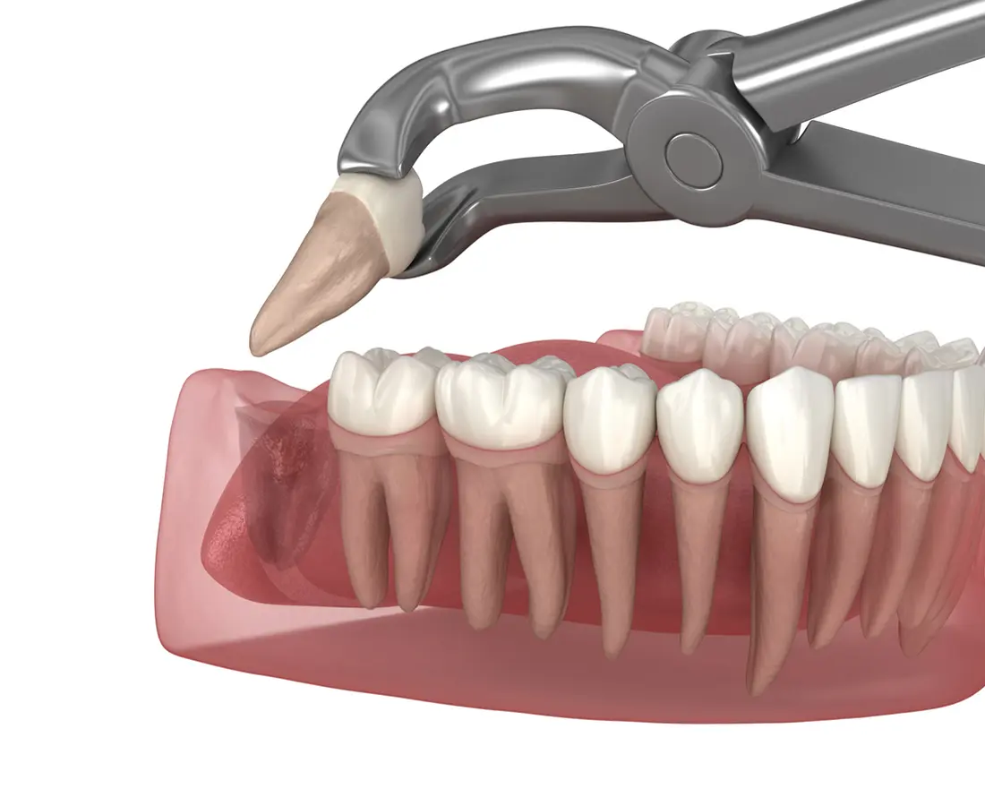 Tooth extraction