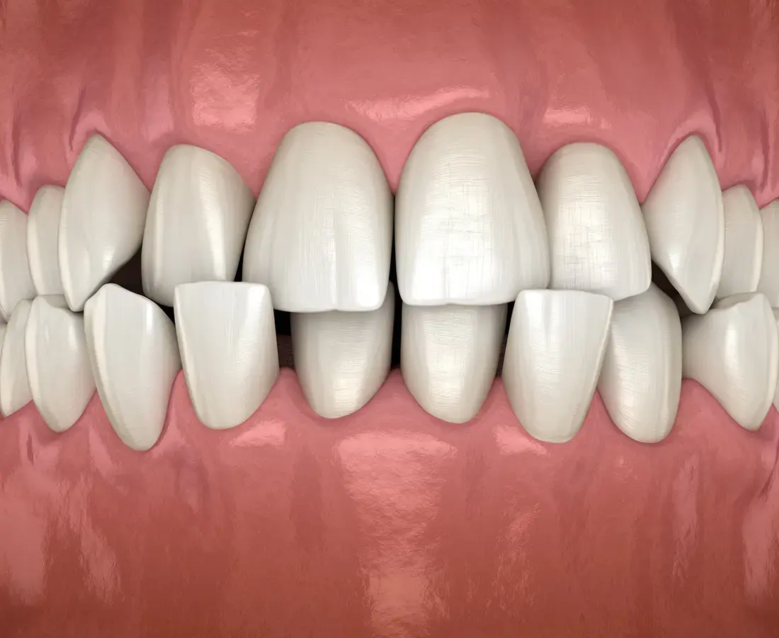 WHAT IS A CROSSBITE