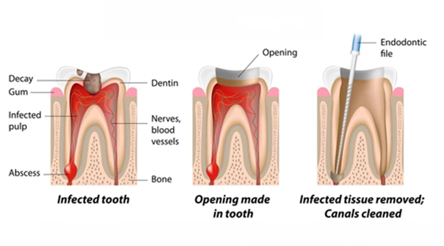 What are the 3 Stages of Root Canal Treatment