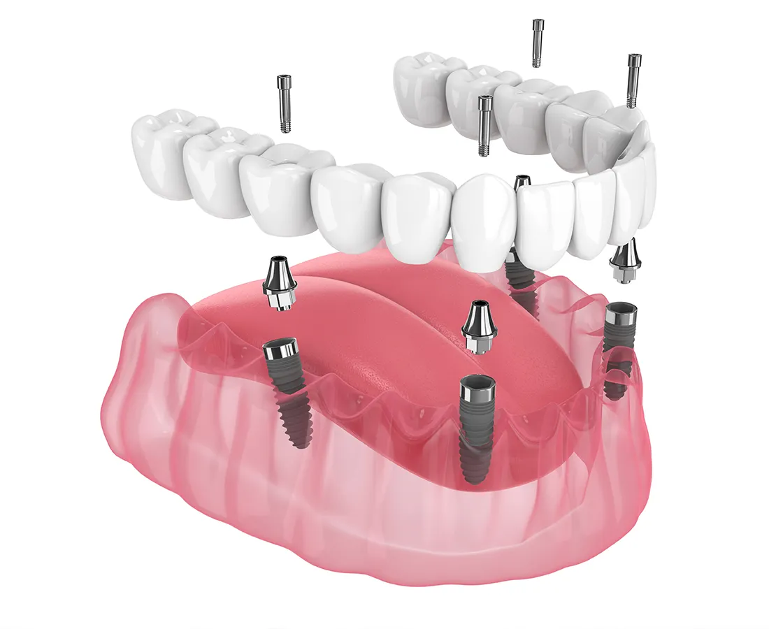 Benefits of All_on_4 Implants