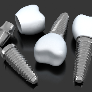 What Are Screwless Dental Implants?